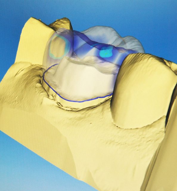 3D image of cerec crowns