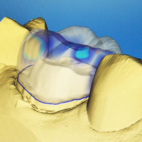 cerec same-day crowns