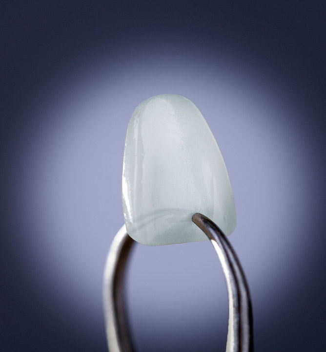 porcelain veneer