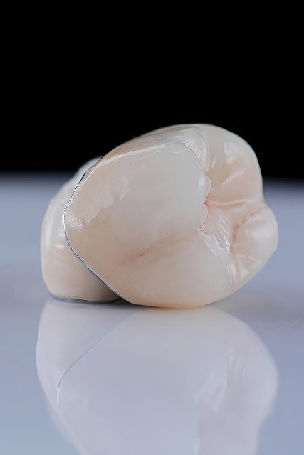 dental crowns in Chicago, IL