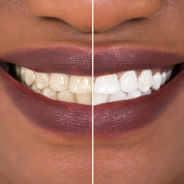 before and after dental treatment with Dr. Clark